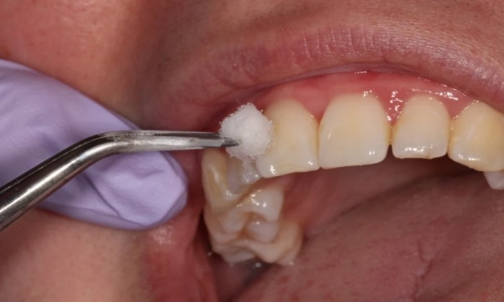 How Endodontists Use Cold Testing To Investigate A Painful Tooth